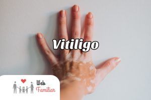 Lee más sobre el artículo 🤩¡Descubre cómo tratar el Vitiligo con Éxito! 🤩