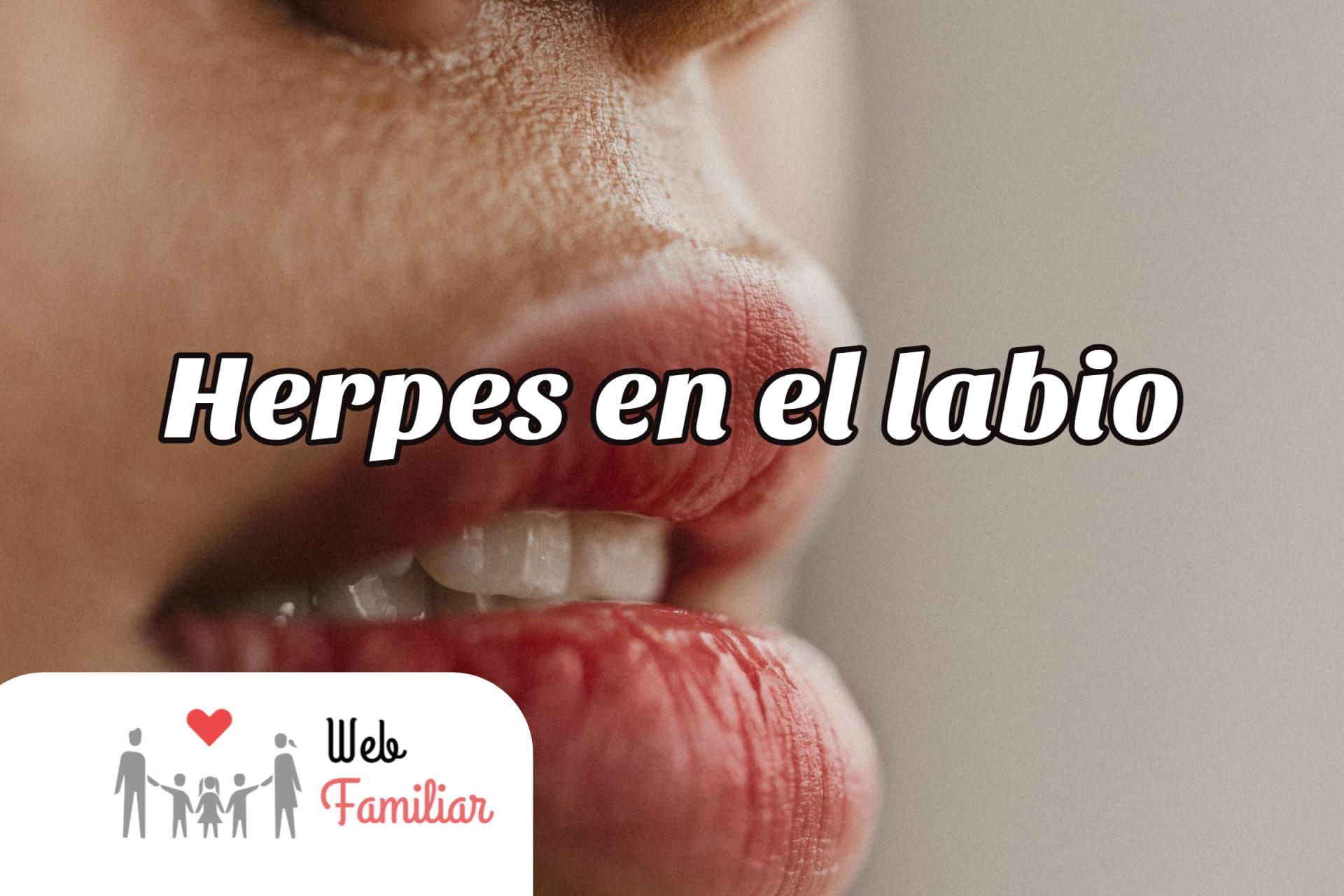 Lee más sobre el artículo ⚡️ ¡Cura el herpes en el labio de forma natural! ⚡️