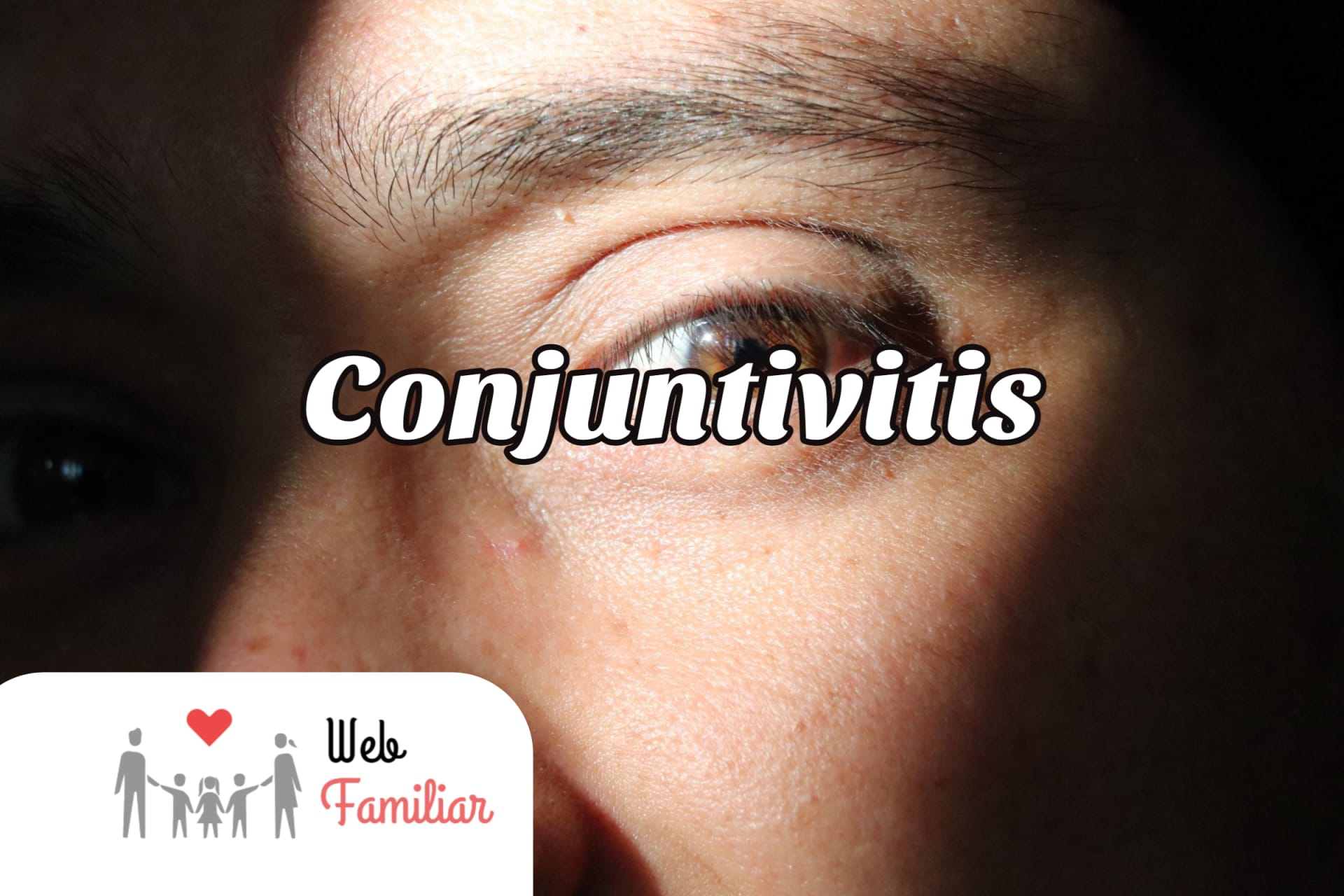 Lee más sobre el artículo 🤧 ¡Cura tu conjuntivitis en 5 pasos! 🤧