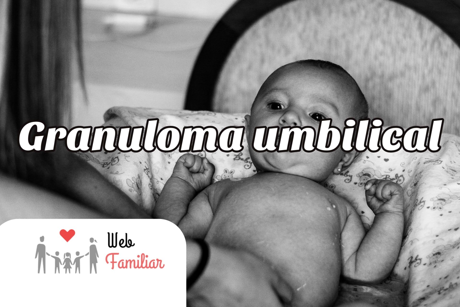 Lee más sobre el artículo 🤰 ¡Descubre todo lo que debes saber sobre el granuloma umbilical!